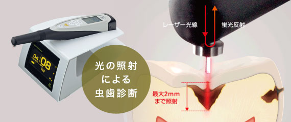 光の照射による虫歯診断