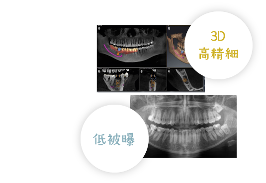 3D高精細 低被曝