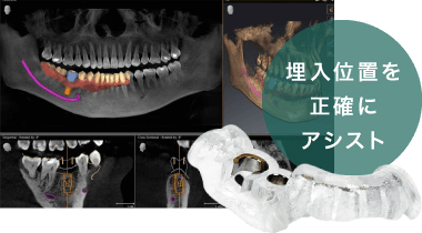 埋入位置を正確にアシスト