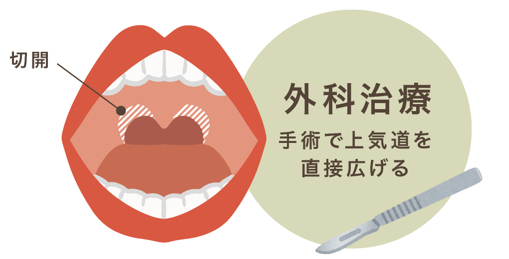 外科治療 手術で上気道を直接広げる