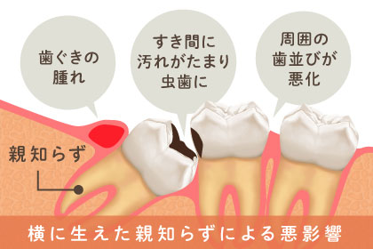 横に生えた親知らずによる悪影響：歯ぐきの腫れ、すき間に汚れがたまり虫歯に、周囲の歯並びが悪化